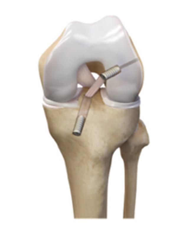 Imagem mostrando a cirurgia de reconstrução do LCA utilizando parafusos absorvíveis