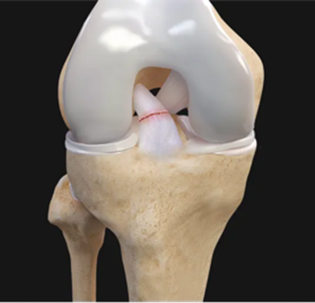 Imagem mostrando local de ruptura do Ligamento Cruzado Anterior (LCA).
