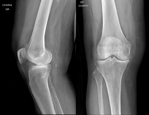 Radiografia do joelho com apoio monopodálico mostrando osteoartrose do joelho com diminuição do espaço articula medial-2