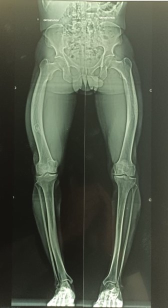 Radiografia panorâmica dos membros inferiores de paciente portador de deformidade grave em varo do fêmur direito e esquerdo
