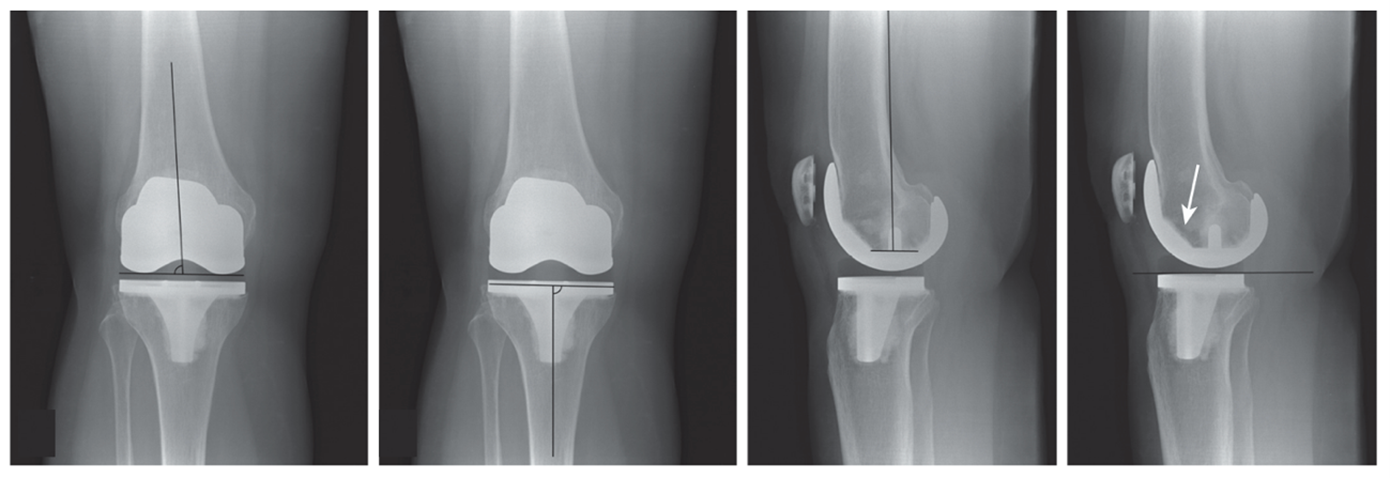 Radiografia pós-operatória de artroplastia total do joelho mostrando o alinhamento dos componentes tibial e femoral.
