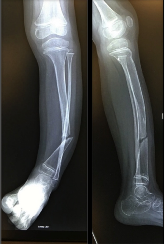 Radiografias da perna de uma criança mostrando pseudoartrose congênita da tíbia antes do tratamento cirúrgico