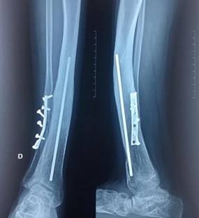 Radiografias da perna de uma pessoa adulta mostrando consolidação de uma pseudoartrose congênita da tíbia com sequela com deformidade angula