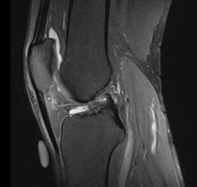 imagem de corte sagital de Ressonância Magnética (RM) mostrando lesão do ligamento cruzado anterior (LCA)