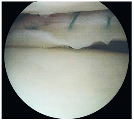 sutura-meniscal-1