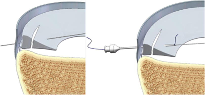 sutura-meniscal-2