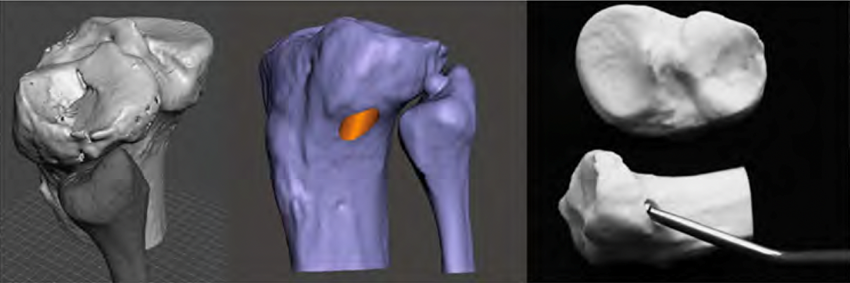 Figura 1: Imagem de uma fratura do planalto tibial lateral com afundamento central seguido da reconstrução e modelagem 3D do osso virtual mostrando o planejamento cirúrgico virtual e a simulação cirúrgica com impressão 3D do modelo ósseo.