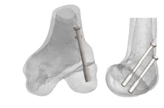 Figura 2: Imagem de uma fratura do côndilo femoral lateral com grande desvio seguido da reconstrução e modelagem 3D do osso virtual mostrando o planejamento cirúrgico virtual e a simulação cirúrgica com posicionamento do implante ortopédico escolhido para o tratamento cirúrgico.